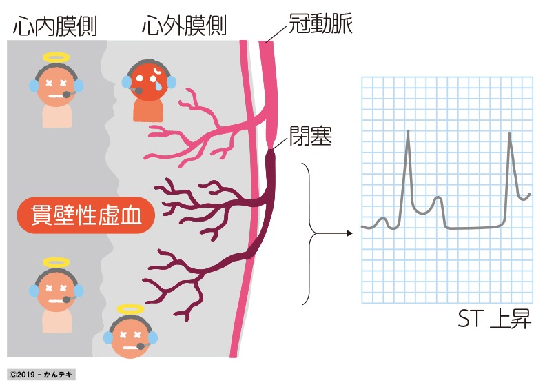 ひとことで言うと 002 St上昇型急性心筋梗塞 臨床ナース メディカlibrary