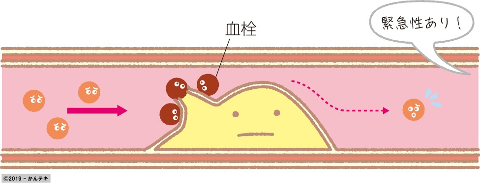 ひとことで言うと 004 不安定狭心症 臨床ナース メディカlibrary