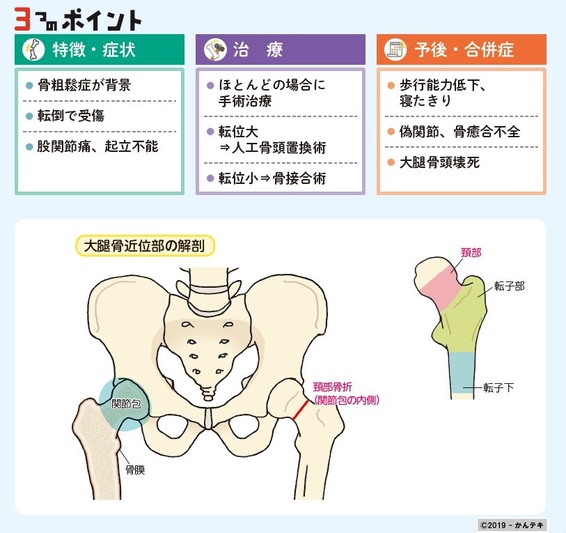 こつこつ せつ だいたい 大腿骨骨幹部骨折｜一般社団法人 日本骨折治療学会
