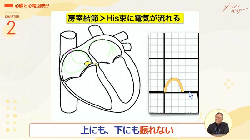 心電図16波形11