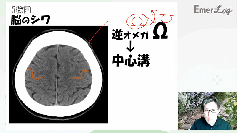 救急ナースのための脳の画像08