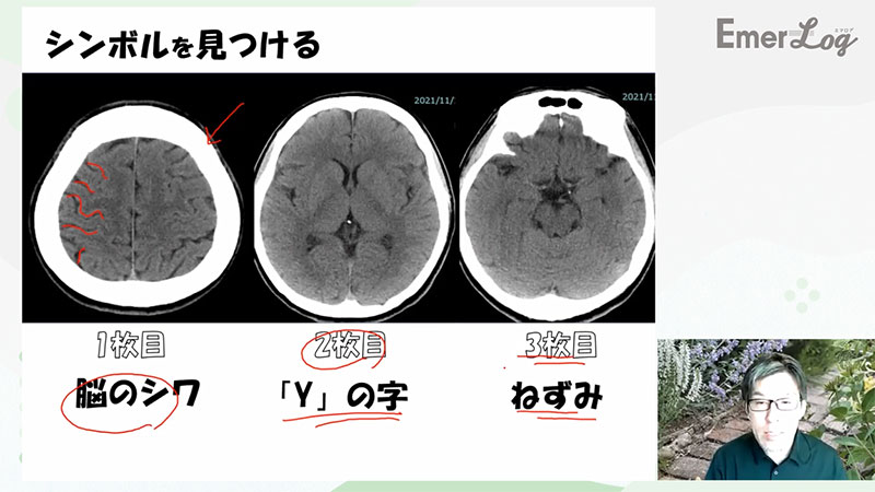 救急ナースのための脳の画像05