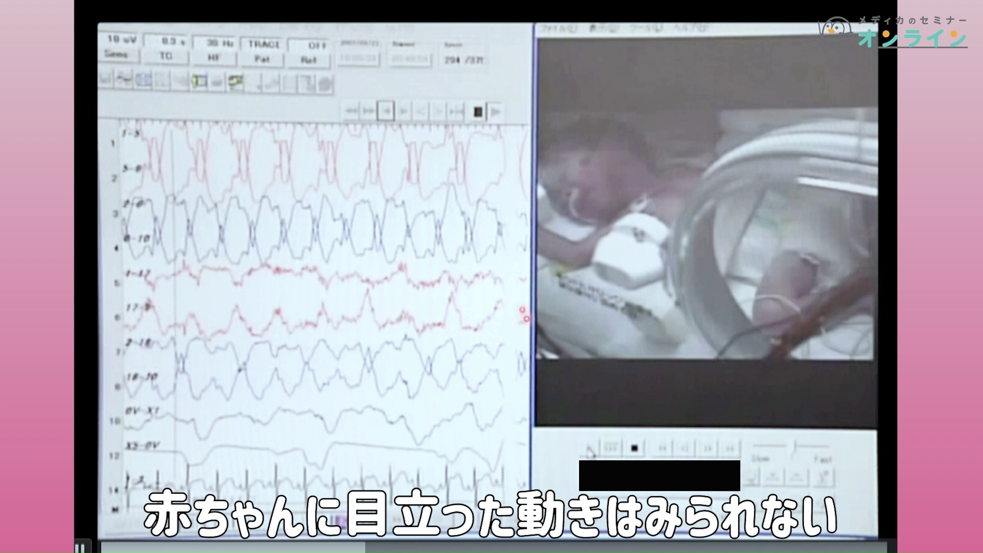 助産師・看護師が知っておきたい正期産児の観察ポイント_症状・疾患編10