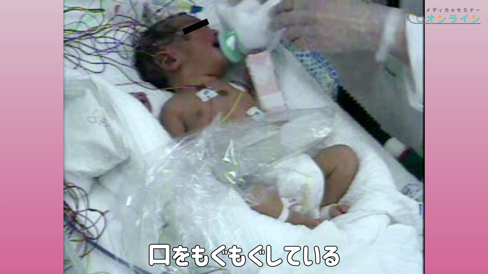 助産師・看護師が知っておきたい正期産児の観察ポイント_症状・疾患編08