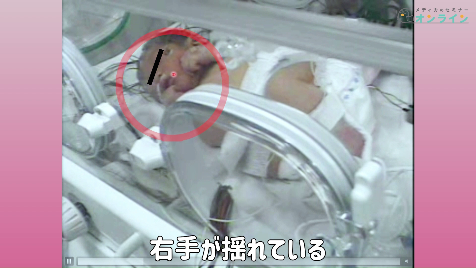 助産師・看護師が知っておきたい正期産児の観察ポイント_症状・疾患編03