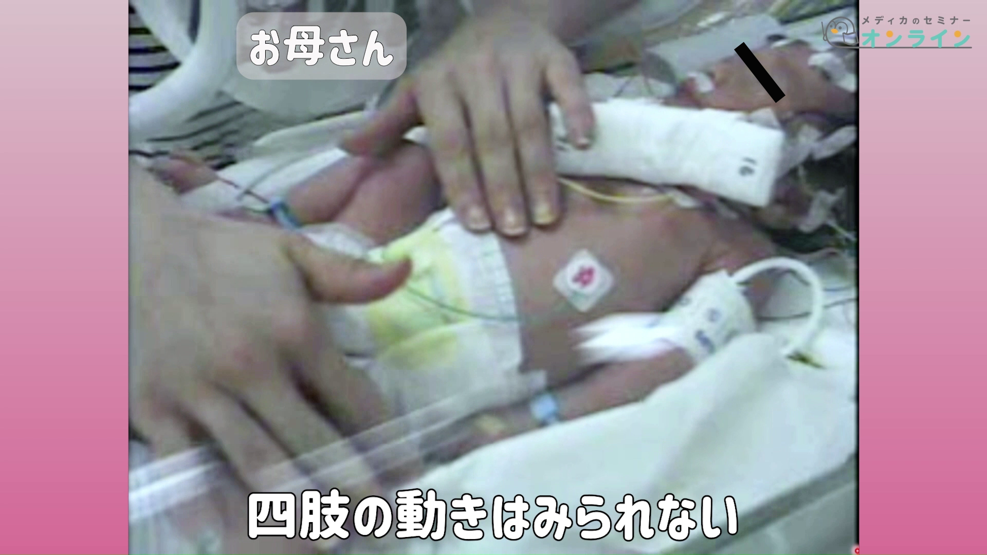 助産師・看護師が知っておきたい正期産児の観察ポイント_症状・疾患編05